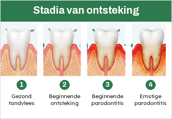 Stadia van tandvleesontsteking, van gezond tandvlees tot ernstige parodontitis