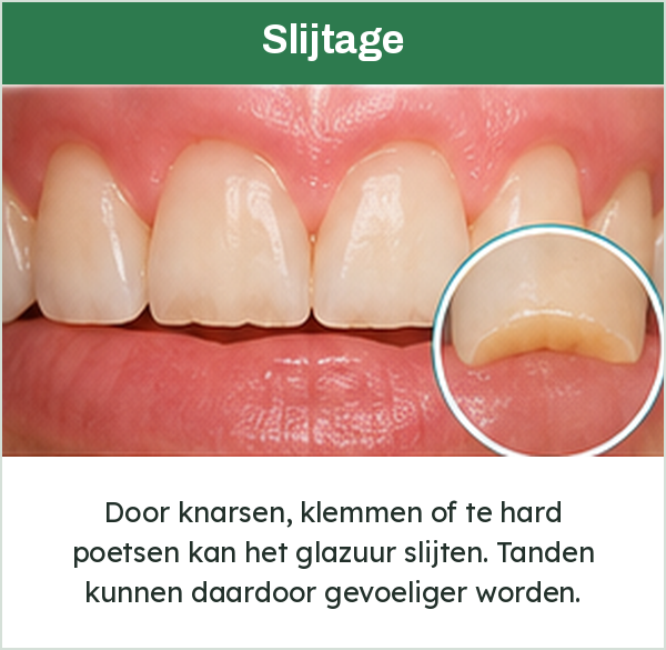 Voortanden met slijtage aan de snijranden