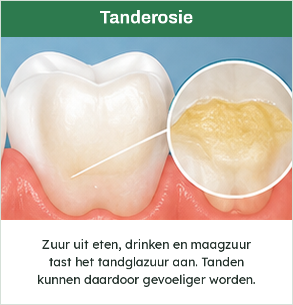 Tand met aangetast glazuur door zuur