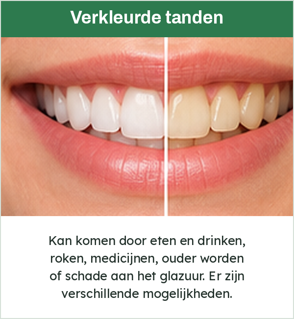 Gebit half wit en half verkleurd