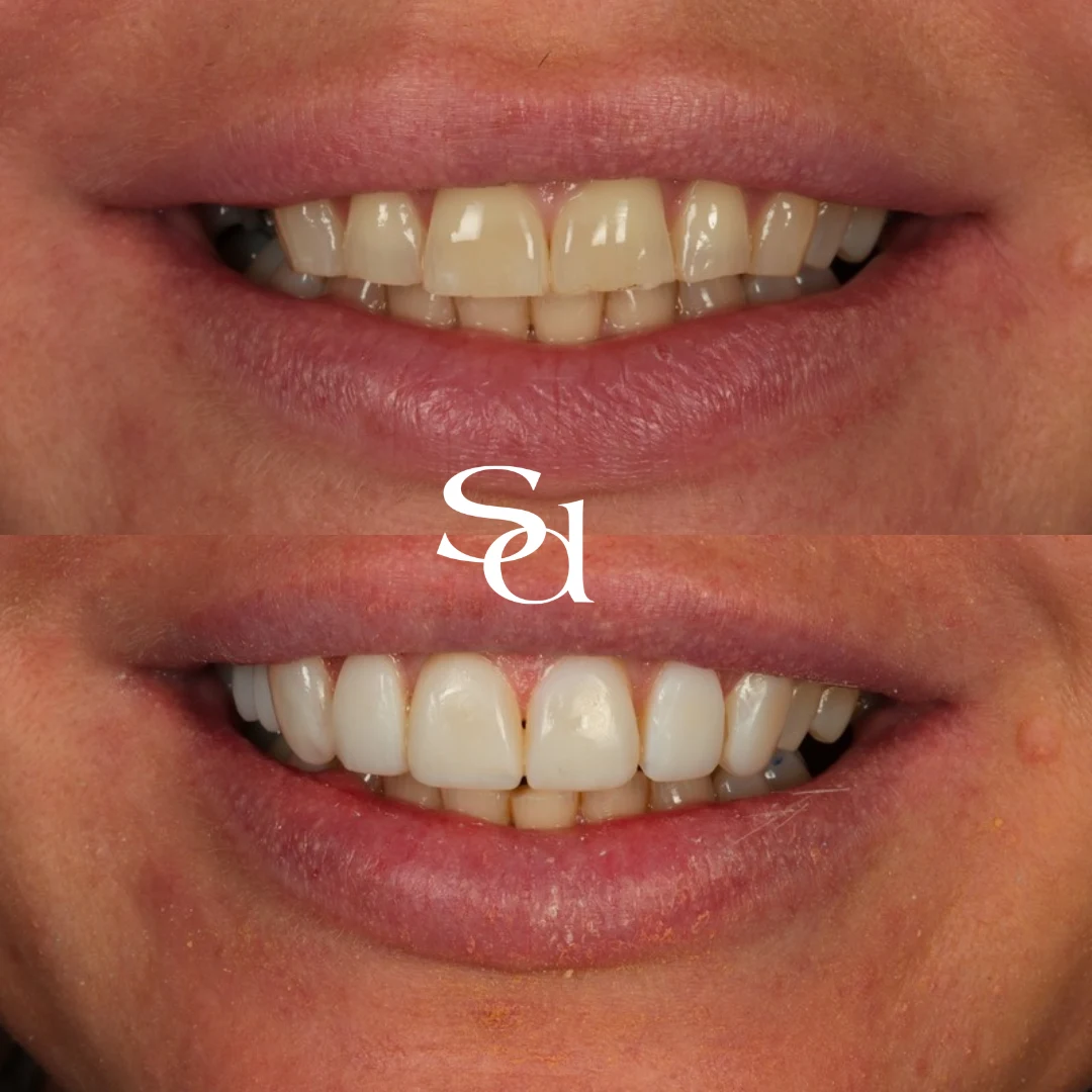 Before and after teeth whitening and composite bonding at Sale Dental Spa