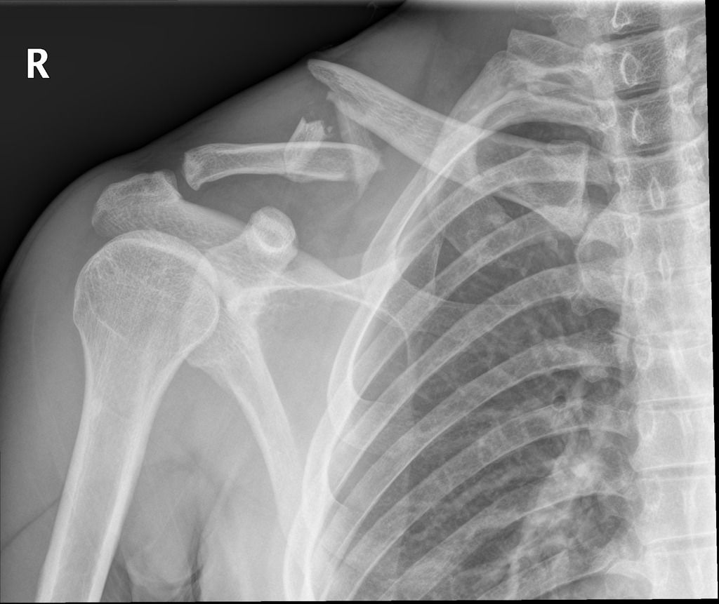 Clavicle Fractures