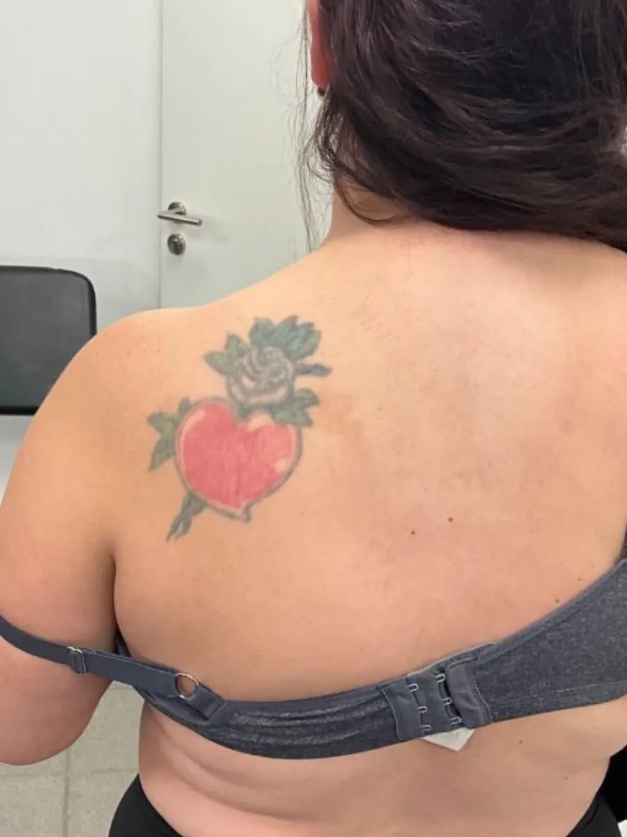 Vorher: altes Herz-Tattoo auf dem Schulterblatt