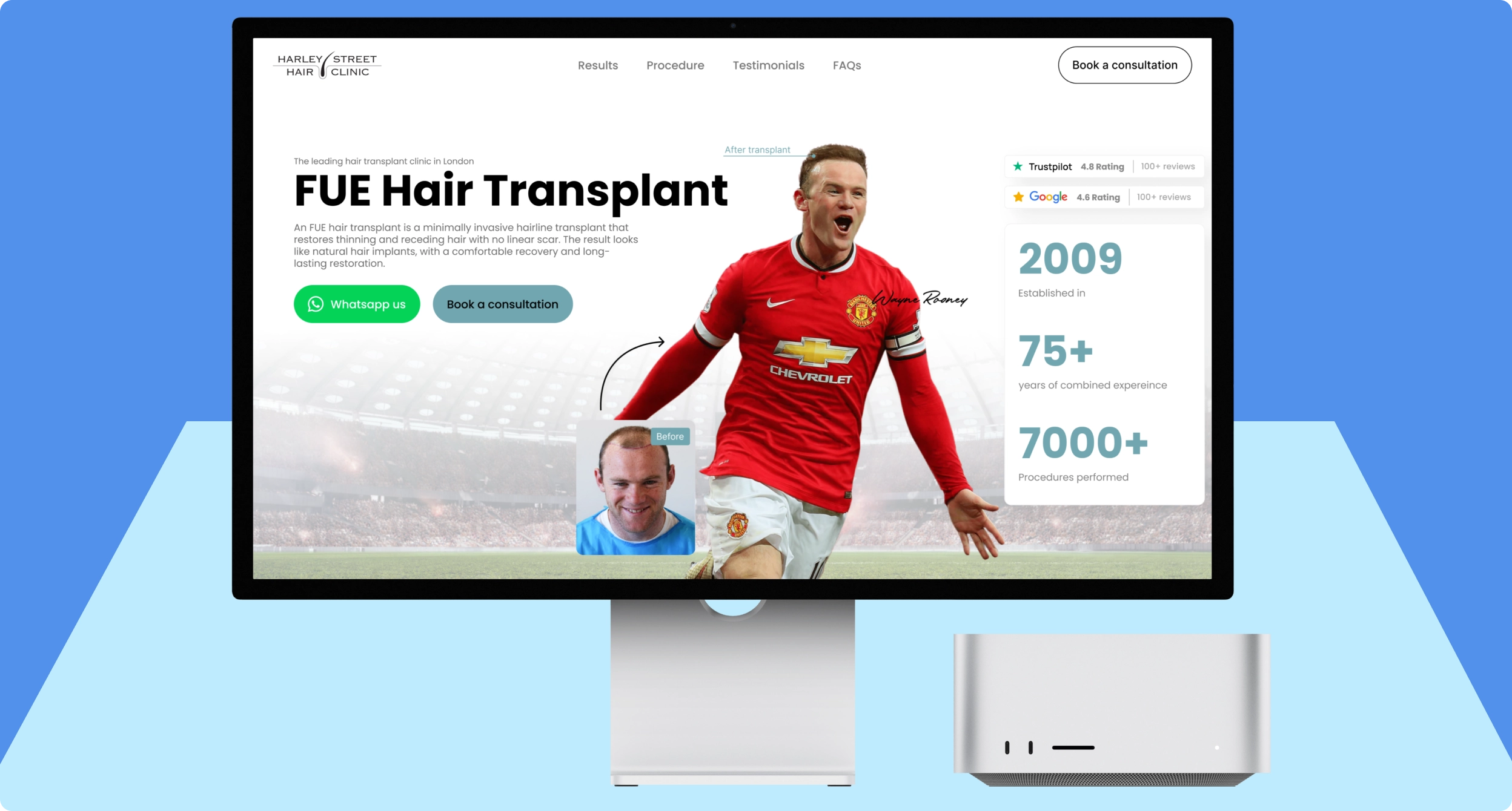 Computer monitor displaying a webpage for Harley Street Hair Clinic's FUE Hair Transplant, featuring a large photo of a man in a red soccer jersey with a hair transplant 'after' image and a smaller 'before' image below, along with clinic ratings, years of experience, and procedures performed.